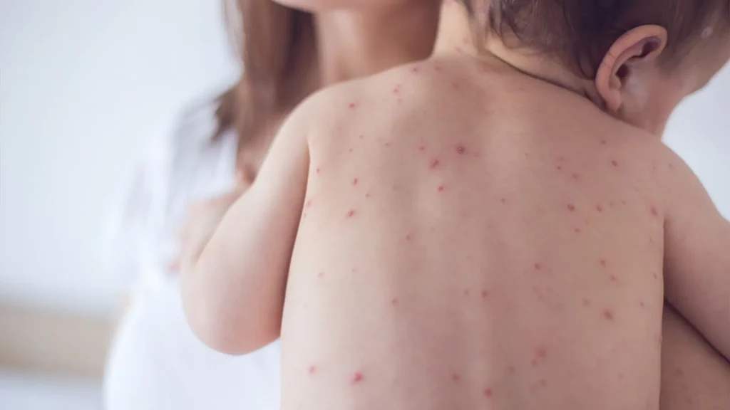 Child with measles
